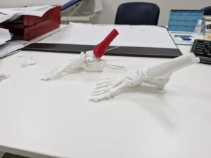 A destra il modellino del piede prima dell'intervento e a sinistra il modellino con la simulazione dell'intervento in rosso (visione laterale)